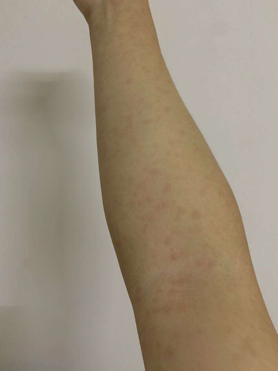 女 三个月前高危行为,最近手臂上出现这种红斑,而且越变越多,是梅毒的