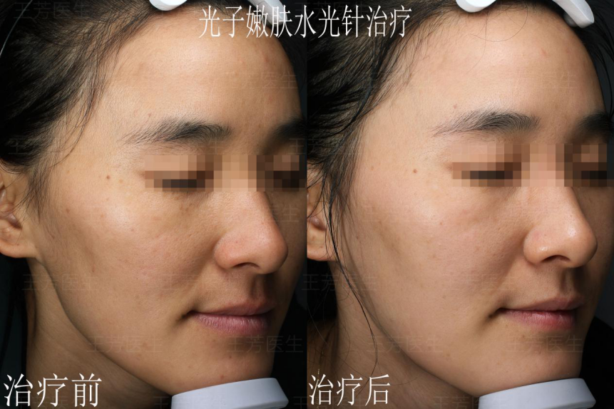 光子嫩肤,水光针案例