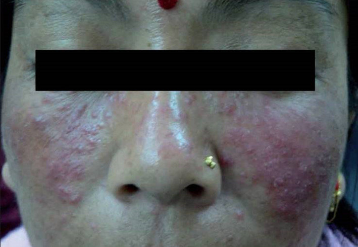 李军友 > 外用激素引起的痤疮样皮炎 口周型:口周中等分散的红斑,丘疹