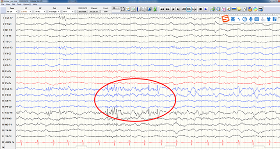 脑电图见睡眠期间歇期放电右侧前头部棘-慢波,多棘-慢波脑电图见清醒