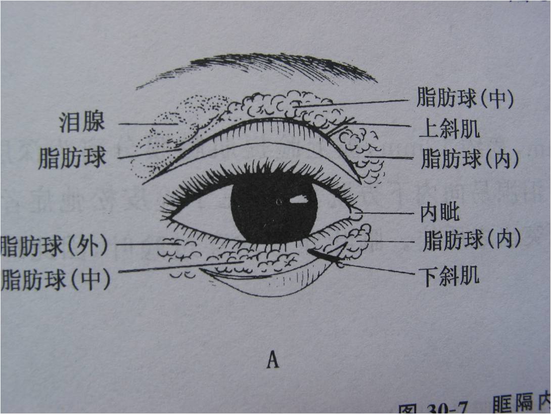 解剖:下斜肌在下睑把脂肪分隔成内侧及中间两部分,外侧脂肪球位置较深