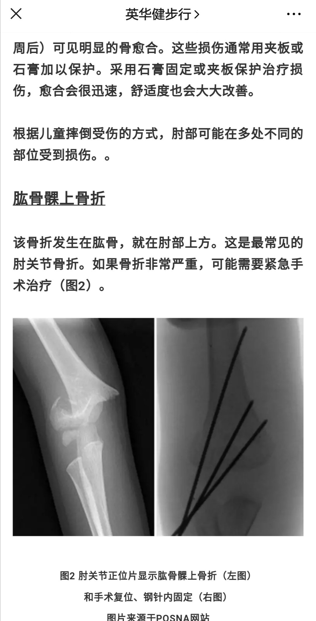 肘部骨折elbowfractures