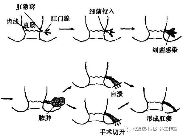 宝宝肛周脓肿咋办