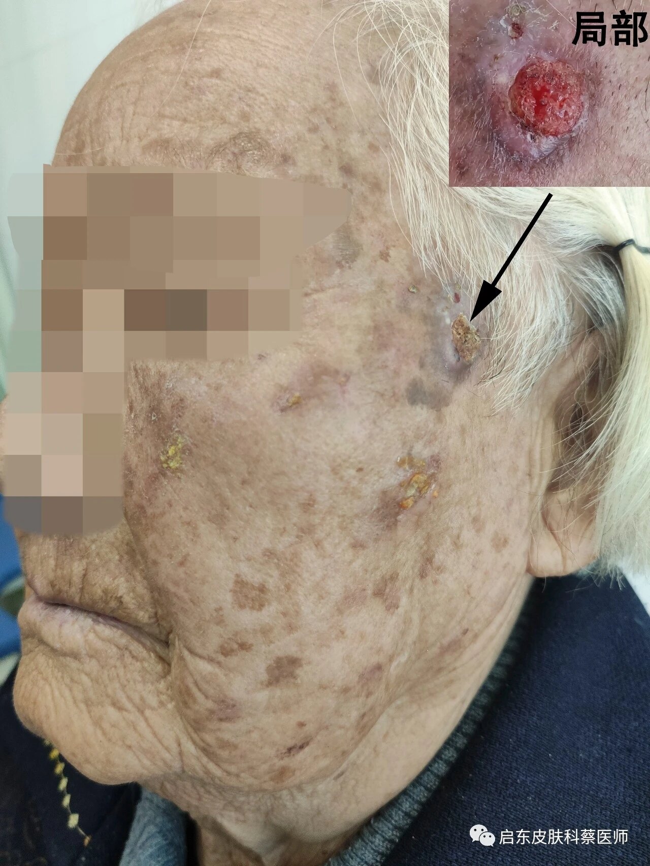 90岁的患者面部scc合并日光性角化一例