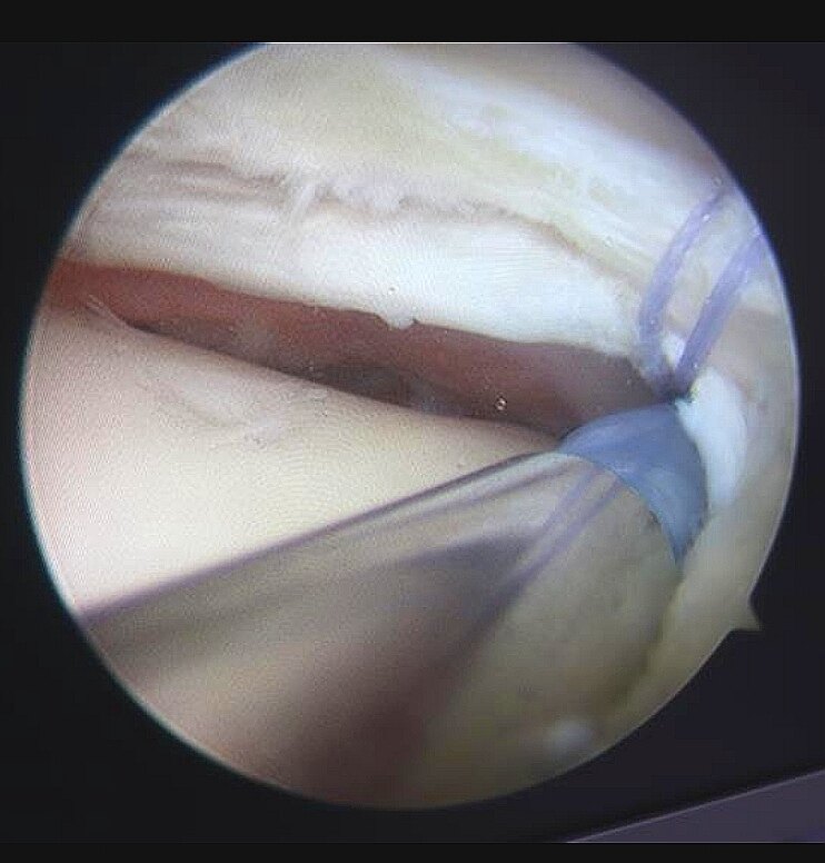 半月板水平撕裂,全关节内缝合法半月板修复术