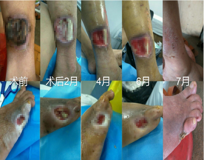 "走走停停"别忽视——警惕"下肢动脉硬化闭塞症"