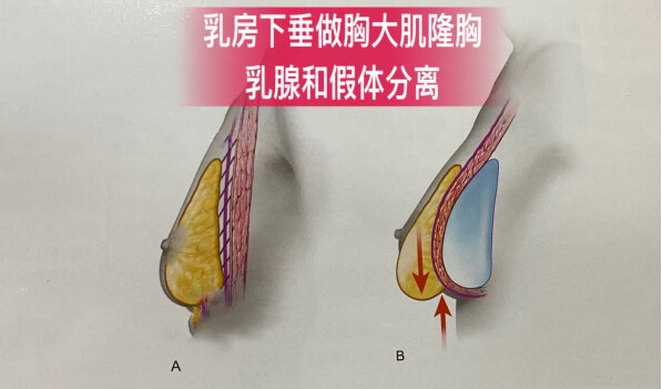 做乳房悬吊 假体隆胸,假体要放在哪个层次?