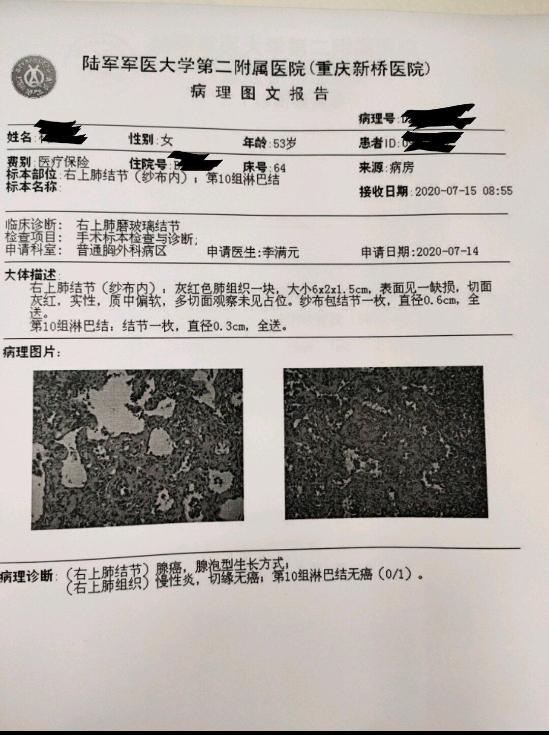 刘懿博士说肺癌一三〇五肺ggn是浸润性腺癌三个月后切晚么