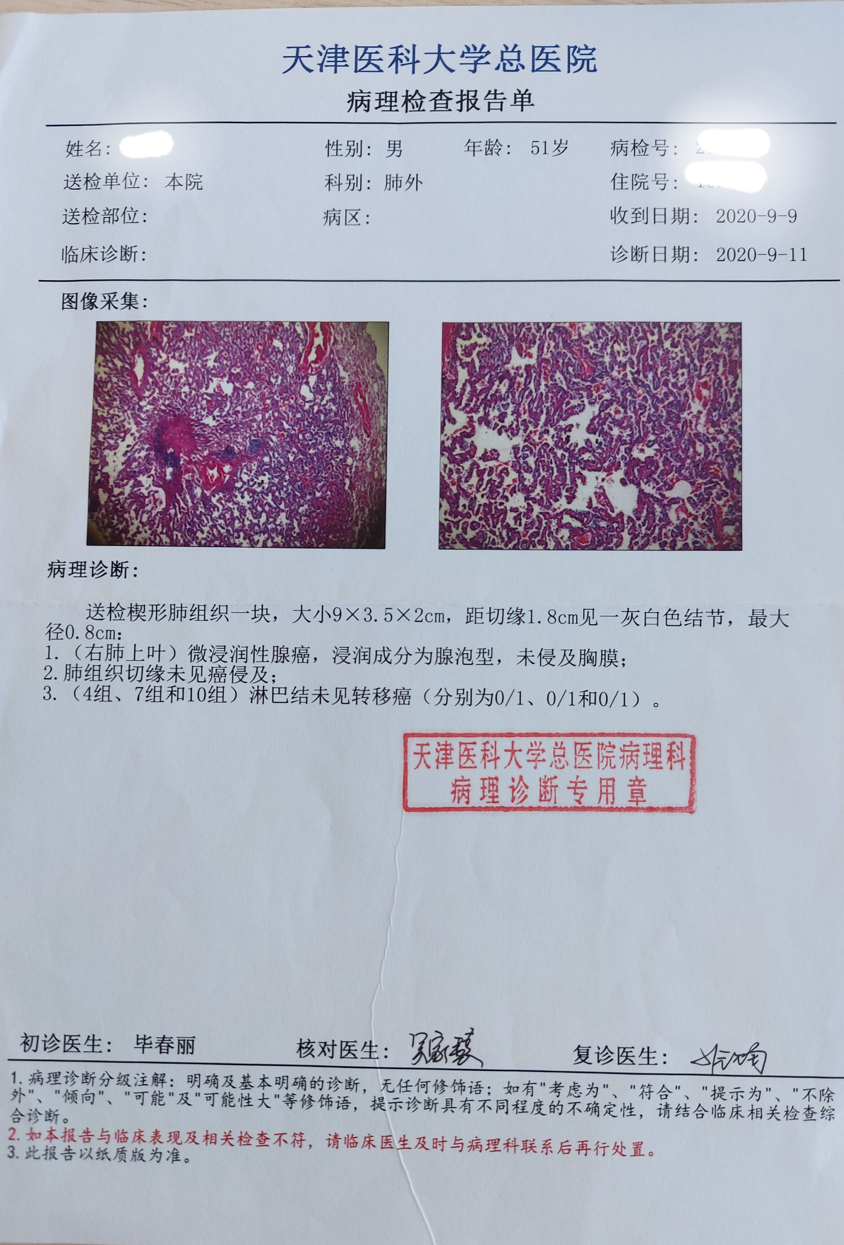 刘懿博士说肺癌(一亖二〇)肺磨玻璃结节观察一年半两次住院终切除