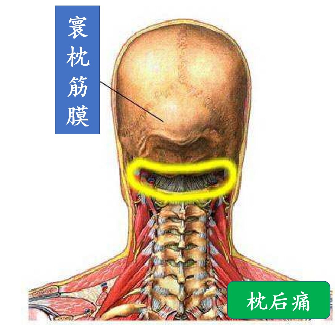 常被颈椎病背锅的寰枕筋膜炎你了解么