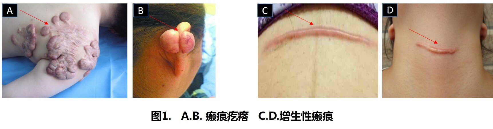 瘢痕的产生,分类,预防和治疗