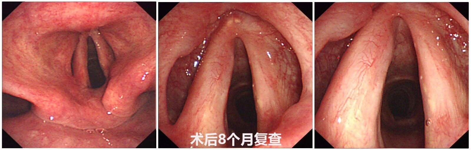 电子喉镜下声带粘连的预防与处理