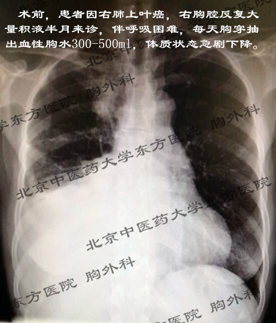 恶性胸水不可怕 彻底控制并不难_胸腔积液 - 好大夫