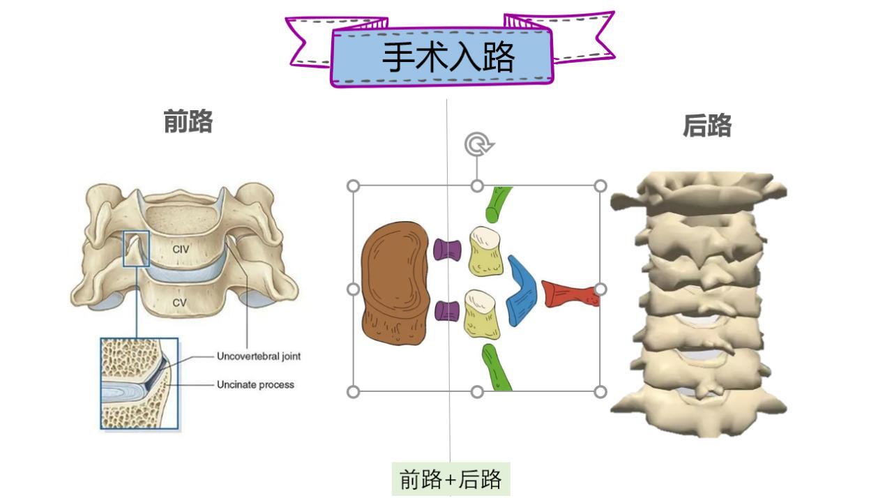 症状轻的颈椎病需要手术吗