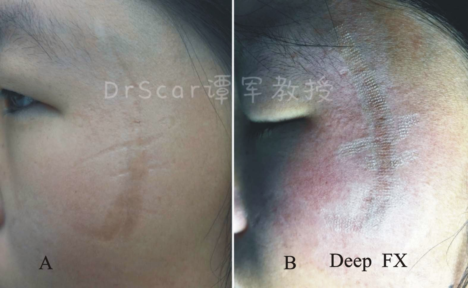 疤痕性体质可以纹眉吗_疤痕性体质和牛皮癣有什么关系_疤痕性体质