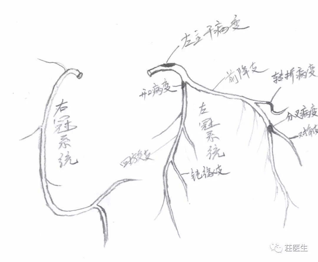 转折处的狭窄,左主干血管的狭窄,包括前降支血管的狭窄(因为乳内动脉