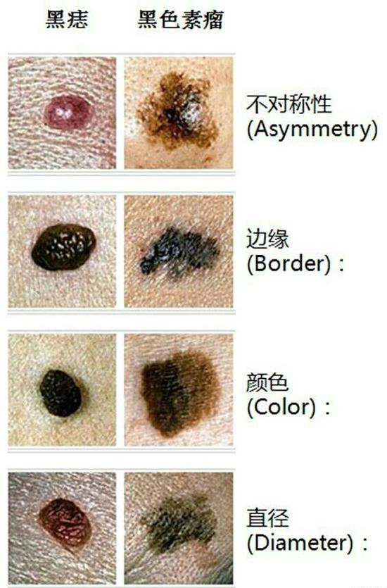 黑痣即色素痣,又名痣细胞痣,黑色素细胞痣,是由于痣细胞增生并产生