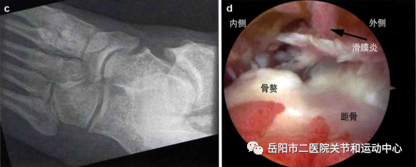 了解关节那些骨刺—前踝关节撞击综合征_骨质增生 好大夫在线