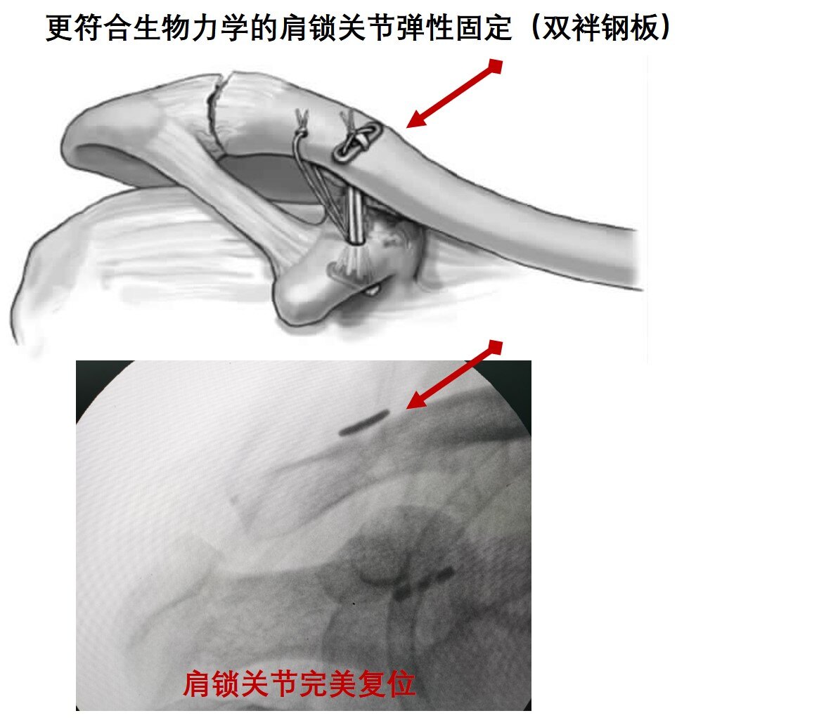 近年来,随着医疗技术不断提高和肩关节镜技术的发展,对于肩锁关节脱位