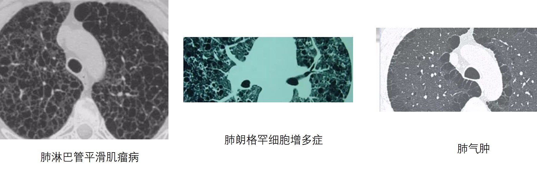 什么是囊泡型肺结节是不是肺癌