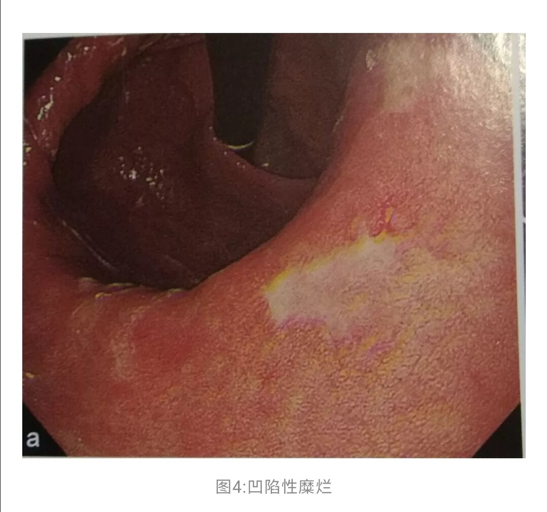 胃黏膜糜烂与幽门螺杆菌感染的关系