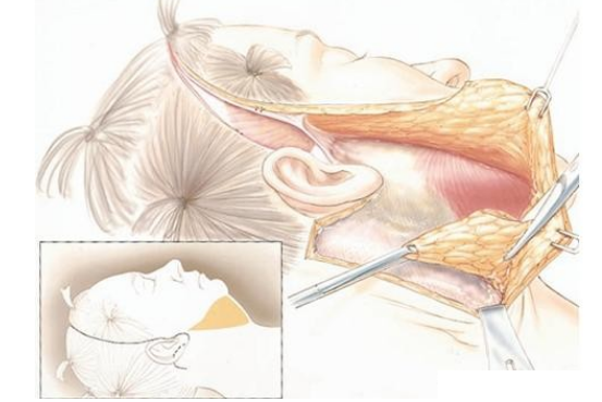 想了解拉皮手术恢复期疤痕后遗症看这篇文章就够了