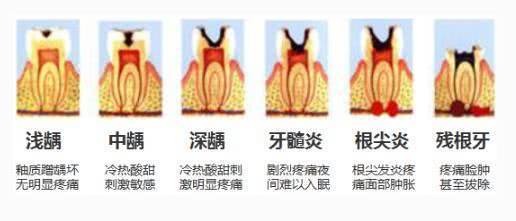 科普牙齿根管治疗,让看牙补牙无忧!