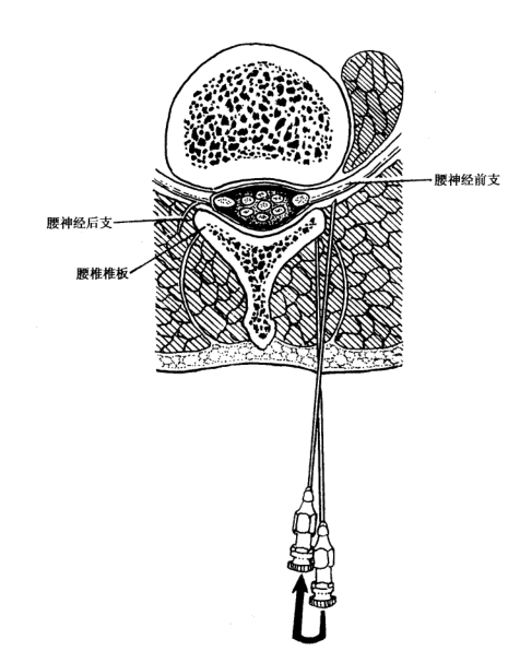 腰椎旁神经阻滞术通过将药物注射在脊神经出椎间孔后的椎旁间隙内使