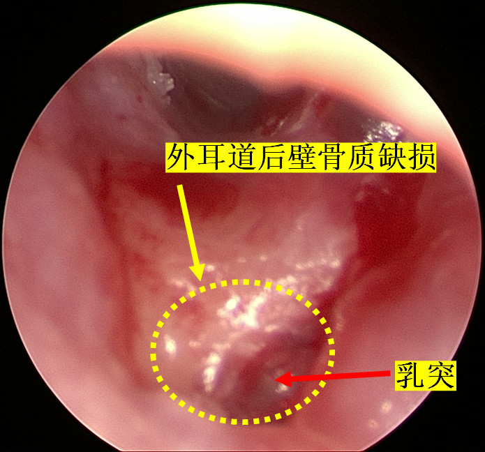 耳内镜下外耳道外耳道胆脂瘤切除术及外耳道后壁重建术