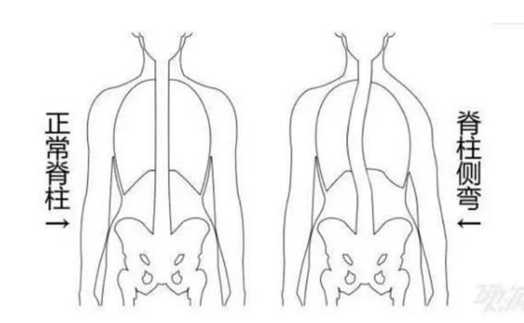 (4)   两侧腰部不对称,一侧(凹侧)腰部出现皮纹褶皱.
