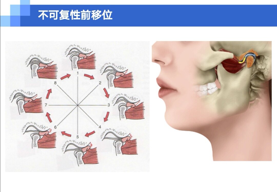 颞颌关节紊乱病(四)