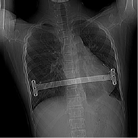 漏斗胸 矫治术,术中放置一根矫形钢板,考虑到患者 漏斗胸 凹陷严重