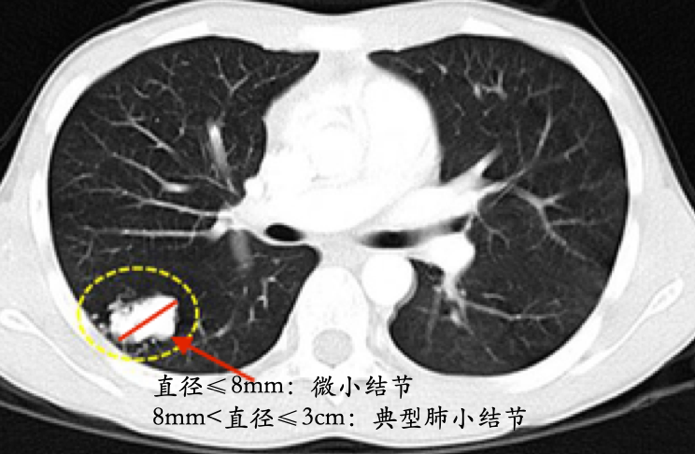 肺部小结节一定是肺癌吗可能只是纸老虎