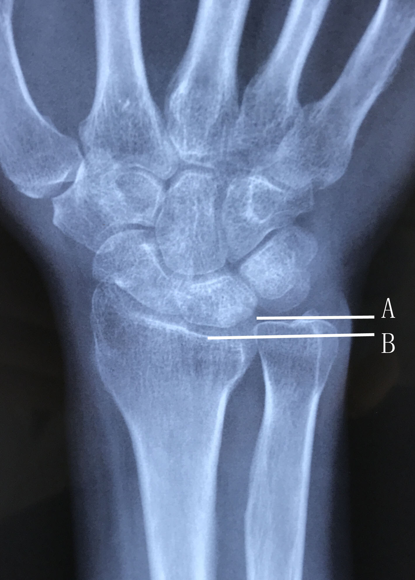 x线可见尺骨正向变异(尺骨头平面高于桡骨远端掌侧缘,月骨尺侧近端