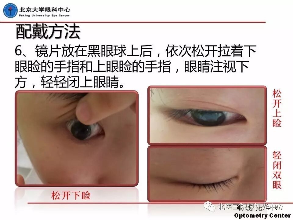 硬性角膜接触镜摘戴方法(北京大学眼科中心)