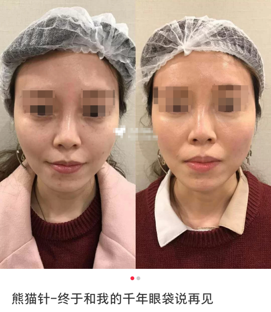 红透网络的熊猫针到底能不能祛眼袋真相到底如何