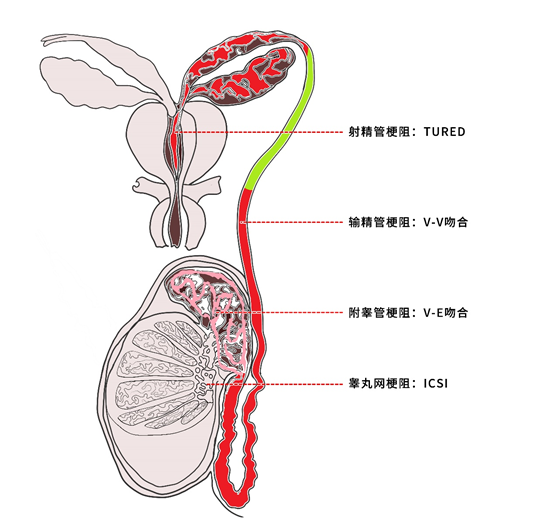 图1  不同输精管道梗阻部位及手术方式