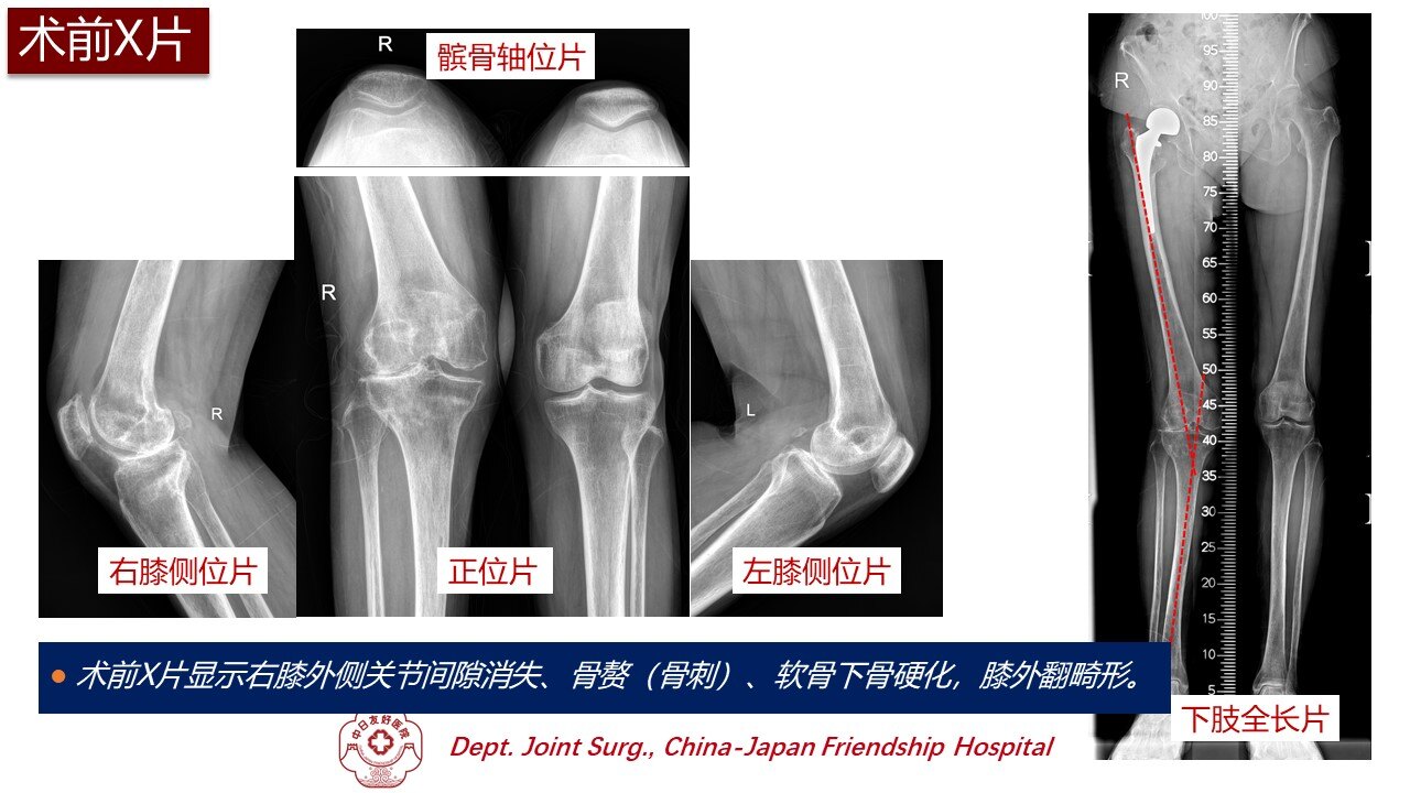 病例:人工智能术前规划全膝关节置换术(2021-k001)