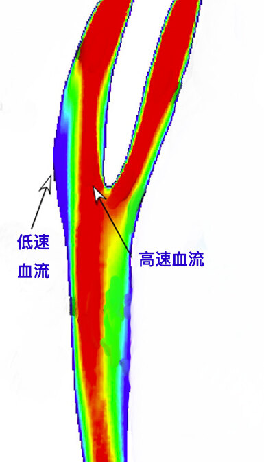 颈动脉血流.jpg