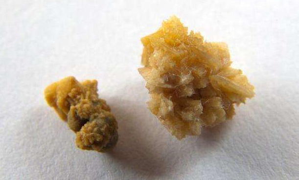 泌尿系结石的独白