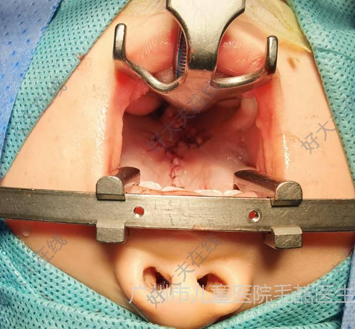 治疗后0天治疗后患者为不完全性腭裂,又叫做硬软腭裂或者二度腭裂.