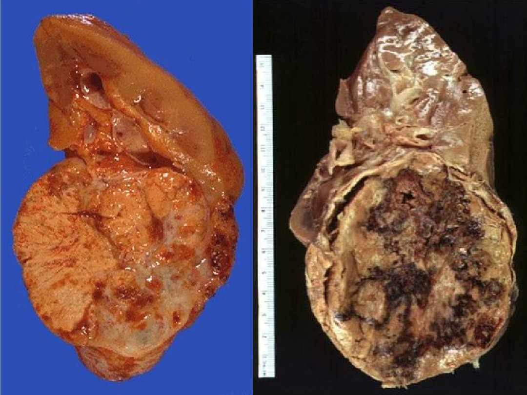 其中以透明细胞癌(60%-85%)最常见,其余的有肾乳头状腺癌或为嗜色细胞