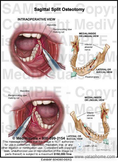 三正颌外科手术步骤