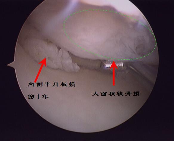 膝关节半月板损伤应该及时微创关节镜手术