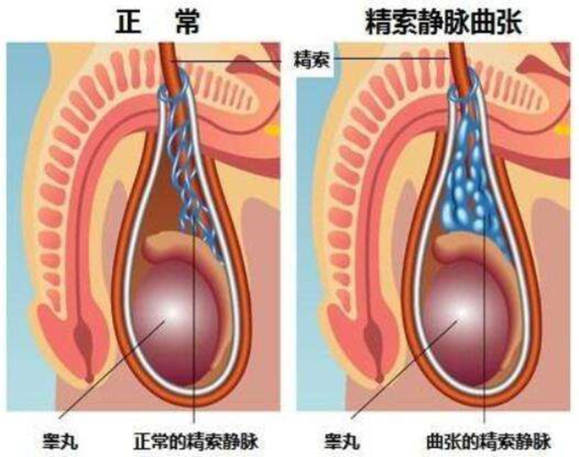 阴囊托在「精索静脉曲张」中的作用