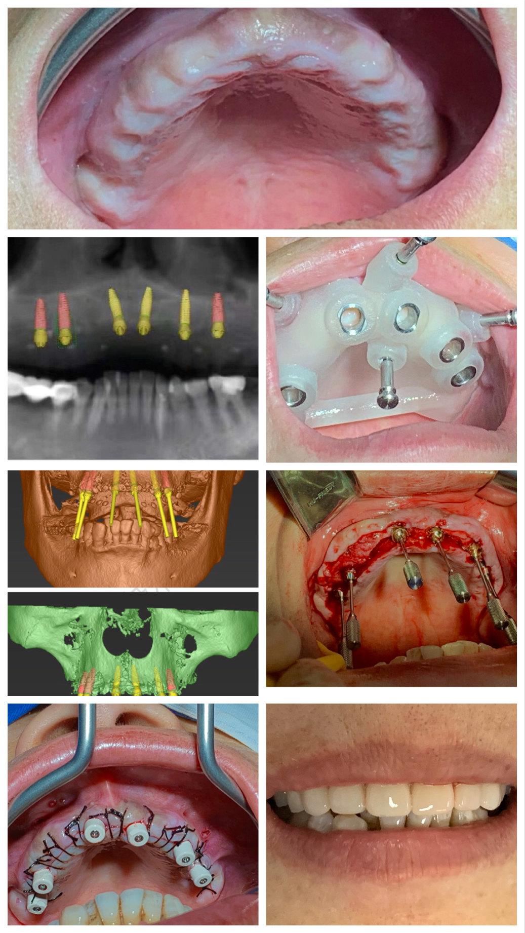 全口种植牙一般流程_牙齿种植 - 好大夫在线