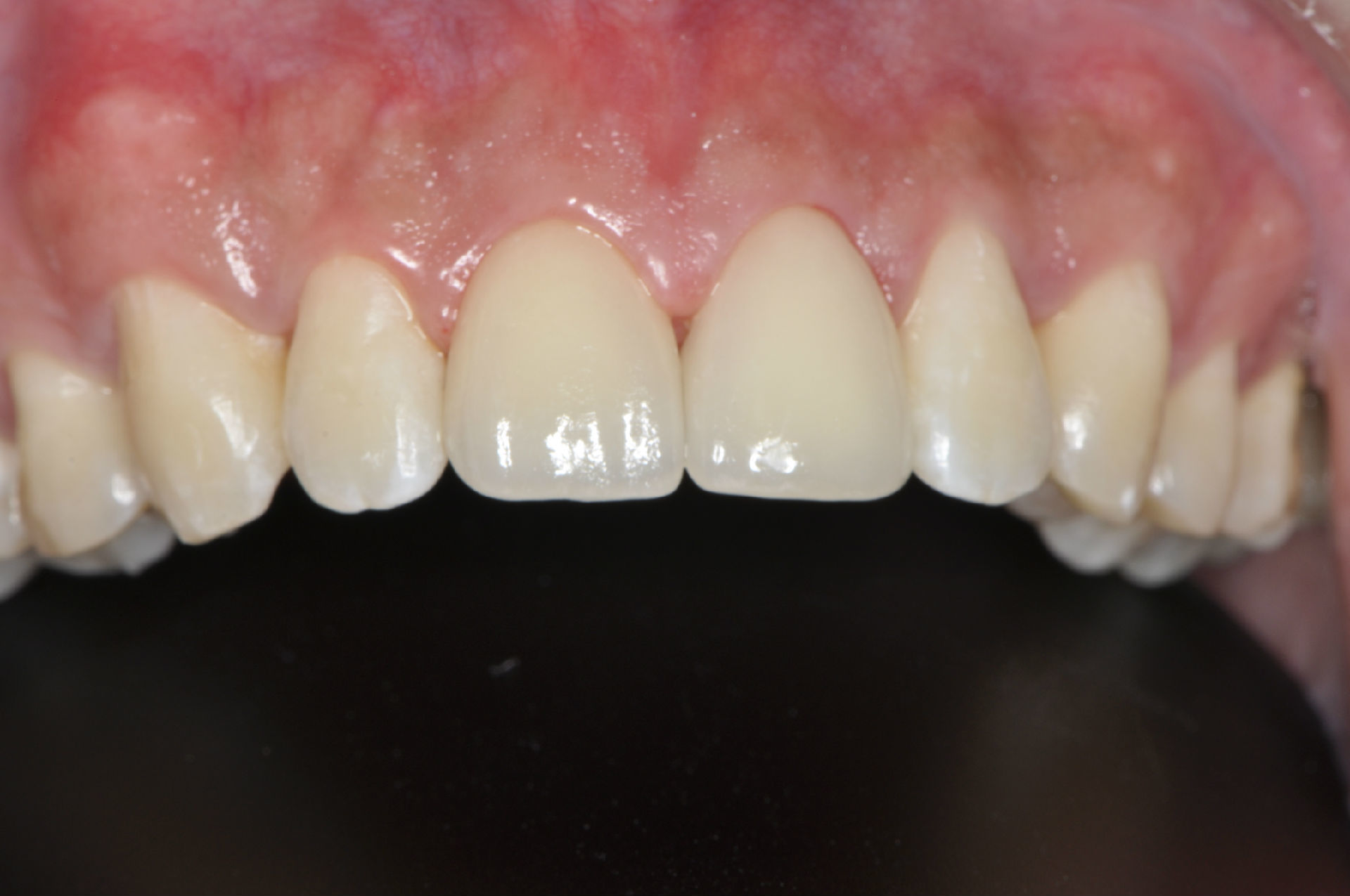 前牙美容--全瓷贴面 - 好大夫在线 ·智慧互联网