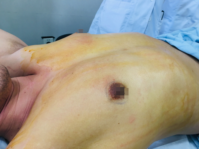 微创旋切术应用于自体脂肪移植隆乳后肿块形成
