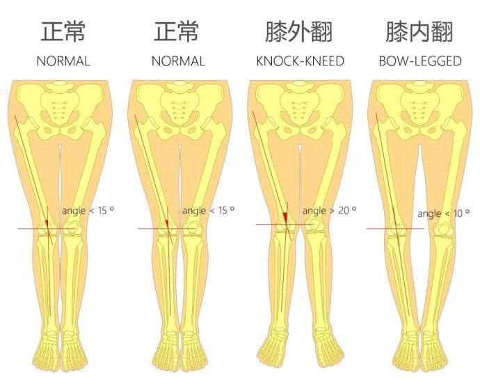 如何分辨腿是外翻还是内翻