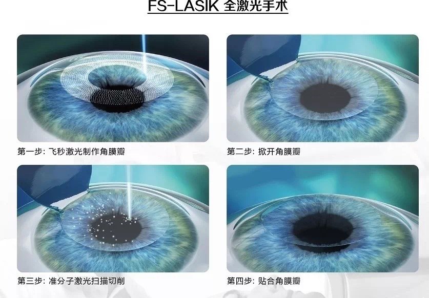 飞秒lasik(半飞秒)手术介绍_准分子激光原位角膜磨镶术 - 好大夫在线